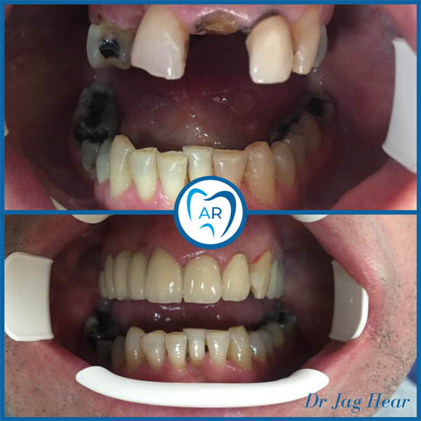 Smile makeover before and after 2